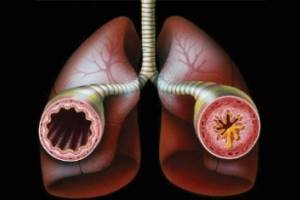 Бронхиальная астма – проблемы и достижения. По материалам 15-го ежегодного конгресса европейского респираторного общества