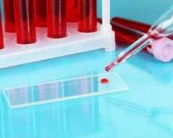 Что показывает анализ крови на щелочную фосфатазу в крови thumbnail